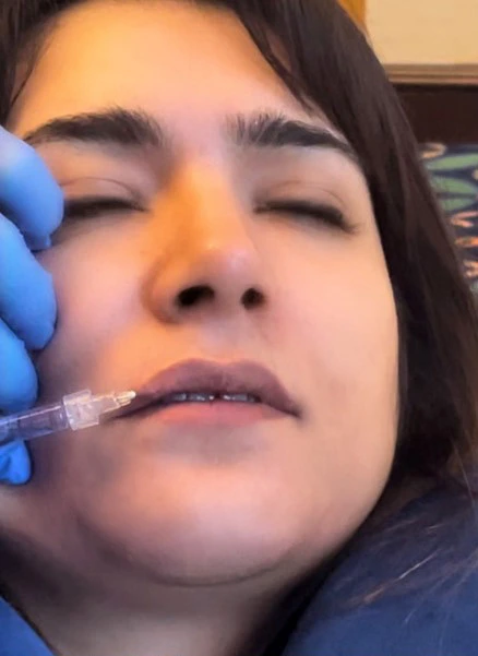 What Are the Benefits of Microneedling for Hair Loss?