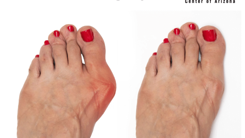 What Are the Risks and Complications Associated with Bunion Surgery?