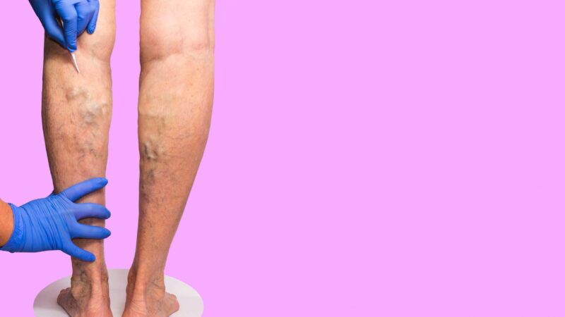 How Do You Know If You Need to Consult a Vascular Specialist?