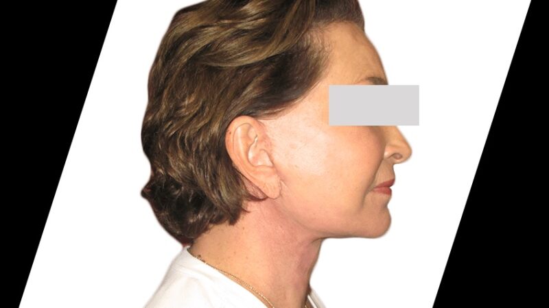 What Are the Benefits of Cheek Reduction Surgery?