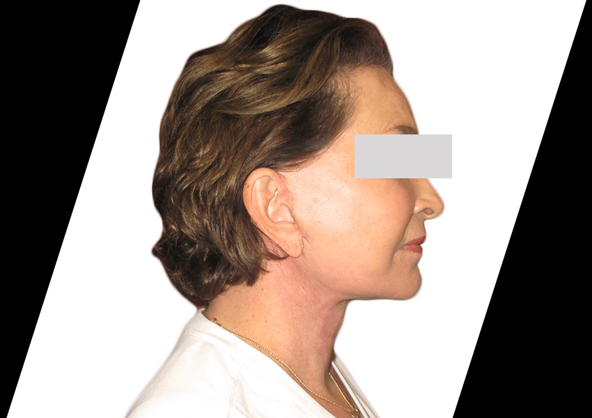 What Are the Benefits of Cheek Reduction Surgery? 1 What Are the Benefits of Cheek Reduction Surgery?