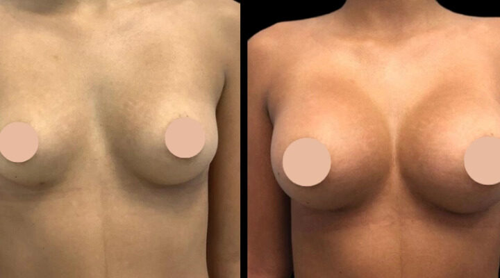 How to Schedule a Consultation with the Best Breast Augmentation Surgeon in Dubai