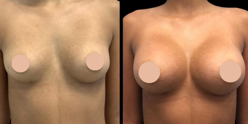 How to Schedule a Consultation with the Best Breast Augmentation Surgeon in Dubai