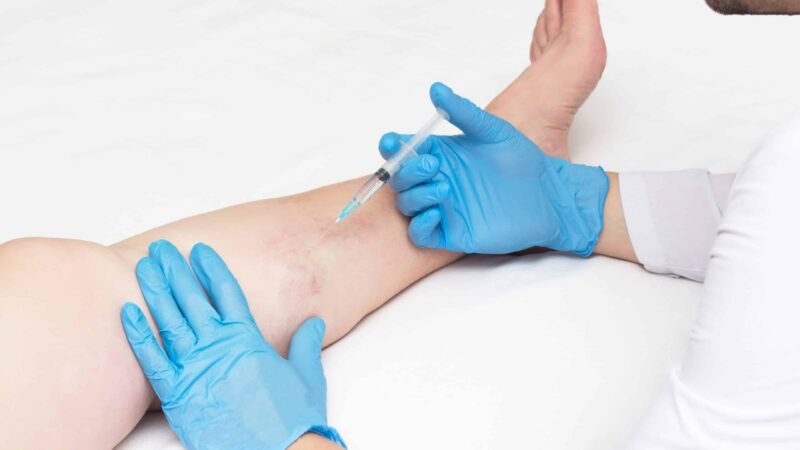 How Effective Are the Newest Varicose Vein Treatments?