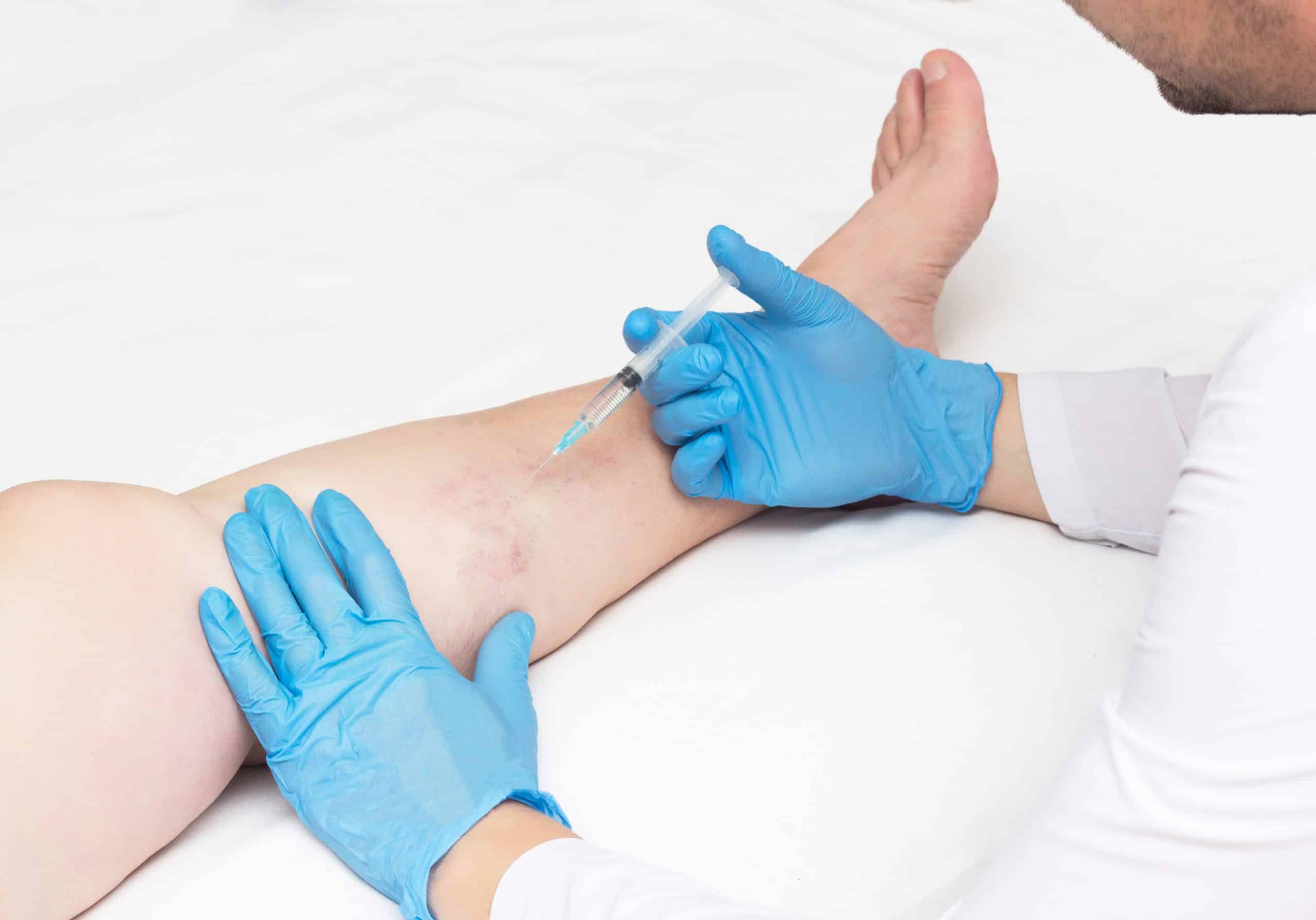 How Effective Are the Newest Varicose Vein Treatments? 1 How Effective Are the Newest Varicose Vein Treatments?