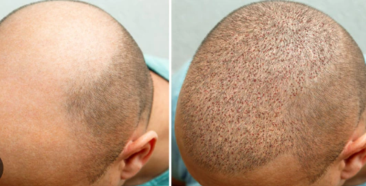 A Comprehensive Guide to Hair Transplant Treatment in Pakistan 1 A Comprehensive Guide to Hair Transplant Treatment in Pakistan