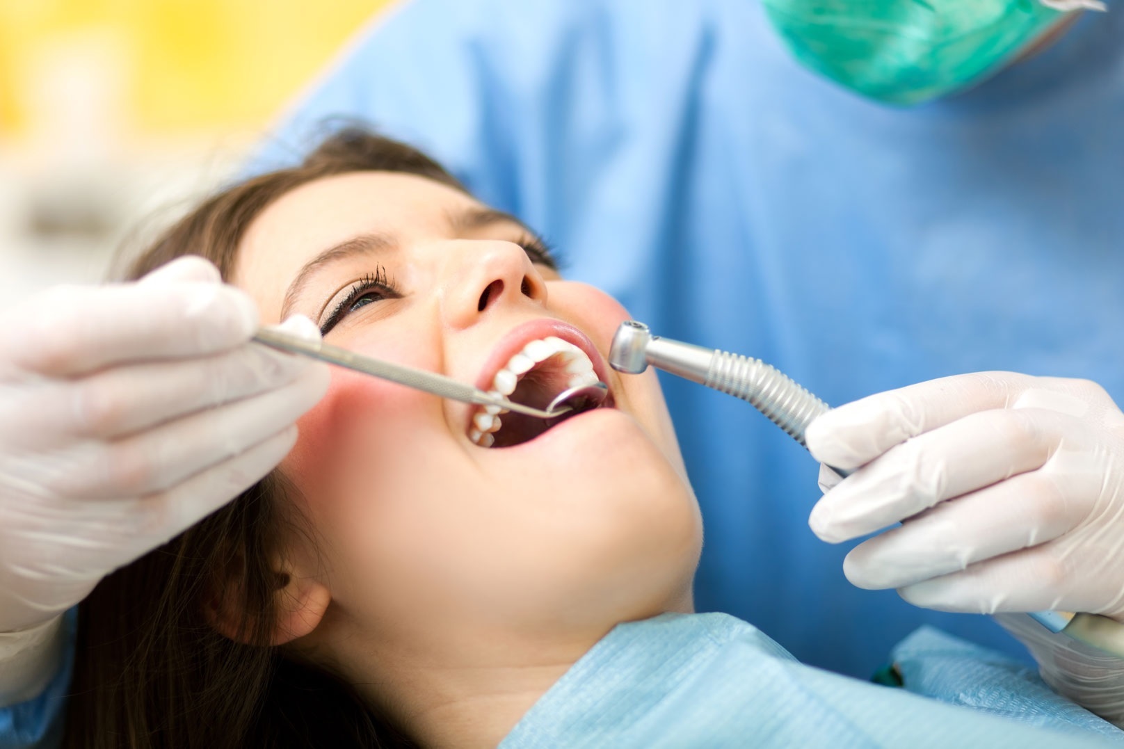 What Is the Cost of Composite Fillings in Houston? 1 What Is the Cost of Composite Fillings in Houston?