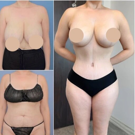 Choosing the Best Tummy Tuck Specialist in Dubai 1 Choosing the Best Tummy Tuck Specialist in Dubai