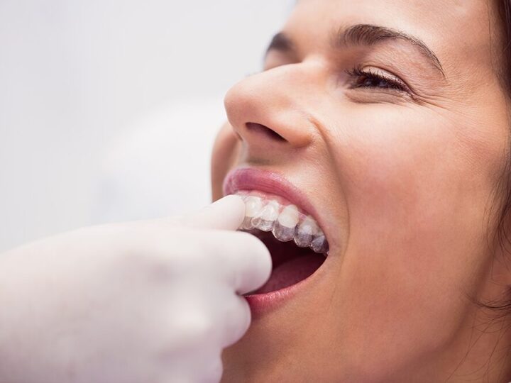 Can You Eat and Drink Normally with Invisible Aligners?