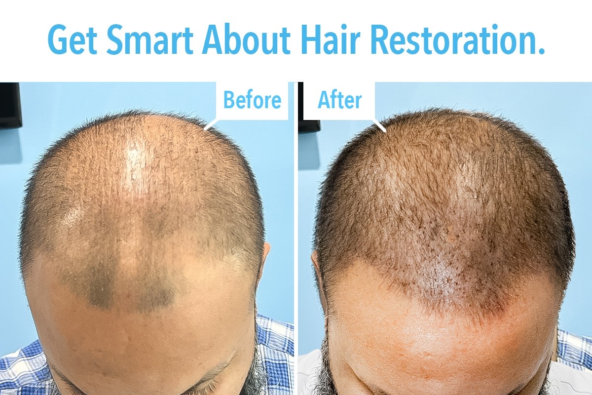What Is SmartGraft Hair Restoration and How It Works