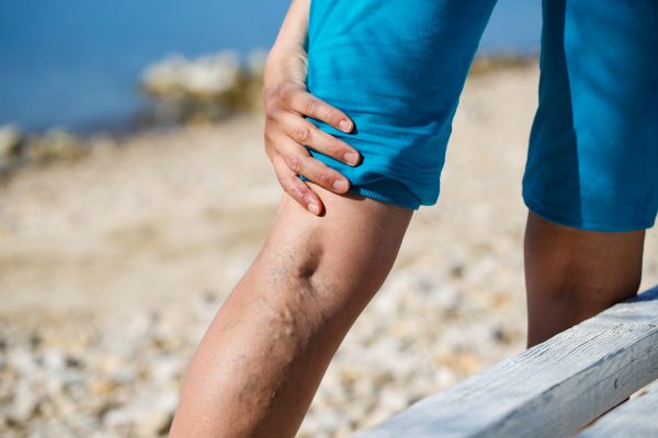 Are Varicose Vein Treatments Covered By Insurance Plans?