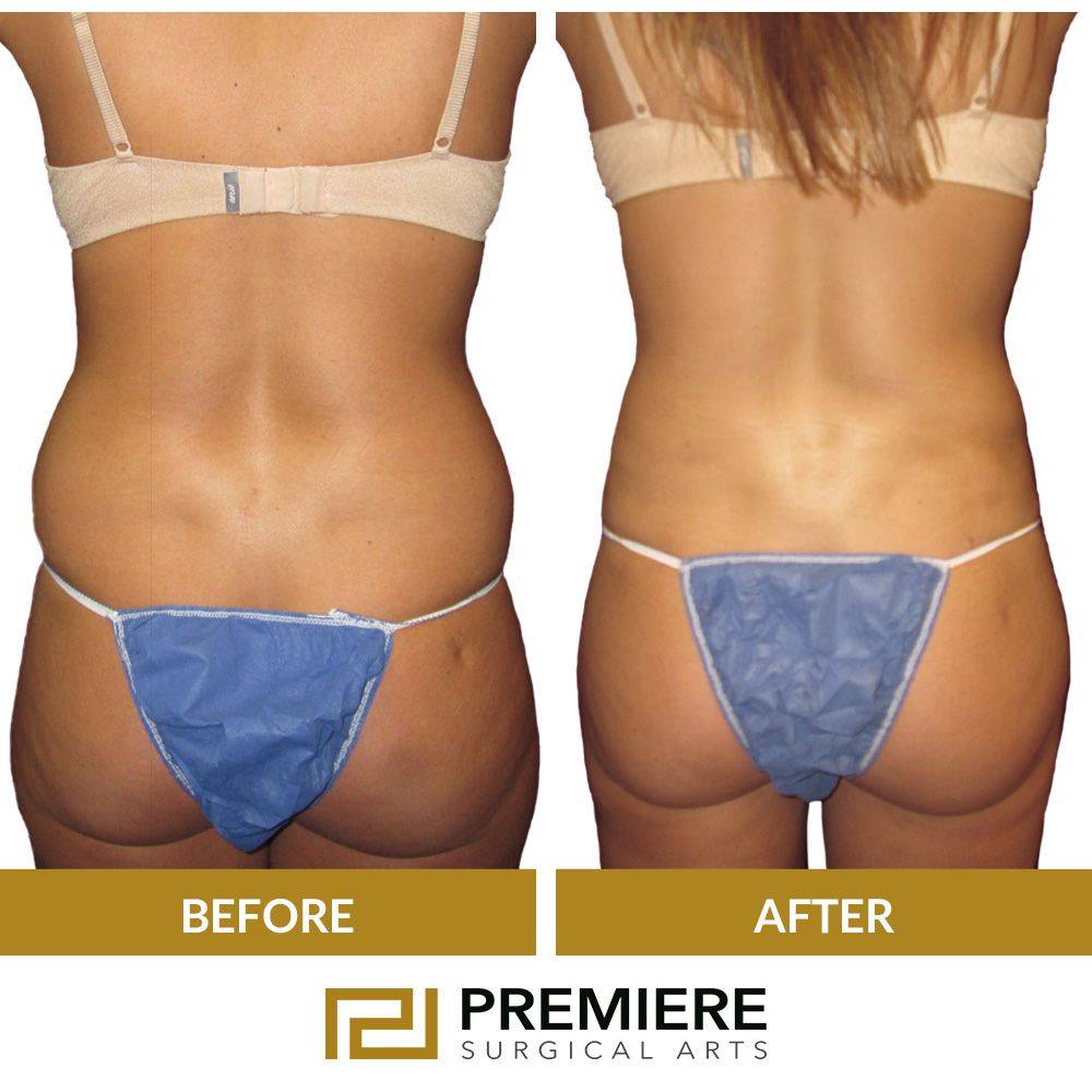 What Are the Risks and Complications of a Brazilian Butt Lift? 1 What Are the Risks and Complications of a Brazilian Butt Lift?