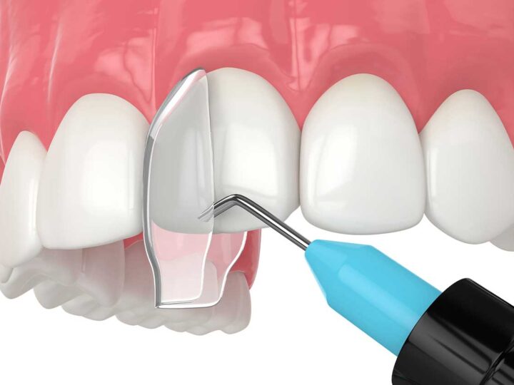 Can I Get Same-Day Cosmetic Bonding Near Me?