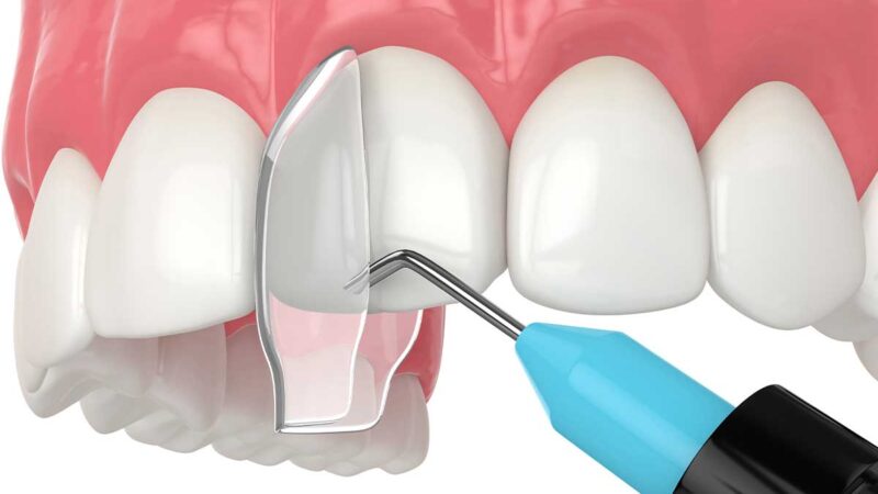 Can I Get Same-Day Cosmetic Bonding Near Me?
