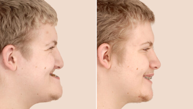 Understanding Underbite Surgery: Procedure, Recovery, and Results