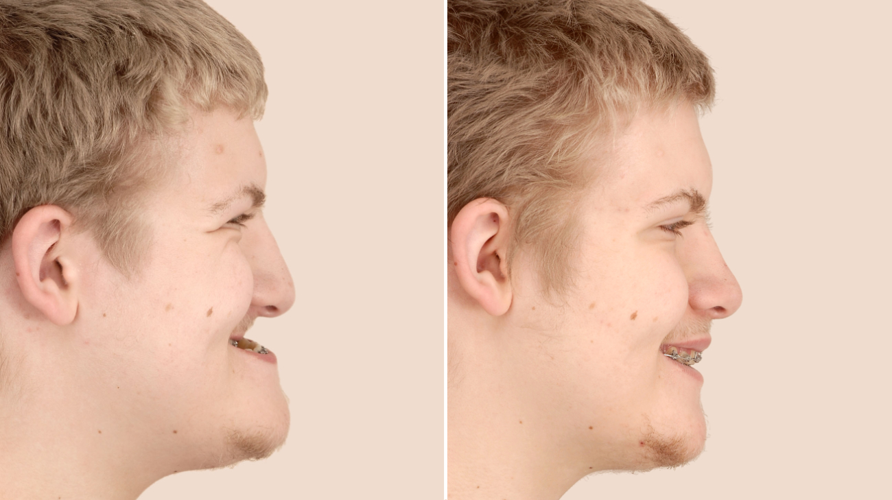 Understanding Underbite Surgery: Procedure, Recovery, and Results 1 Understanding Underbite Surgery: Procedure, Recovery, and Results