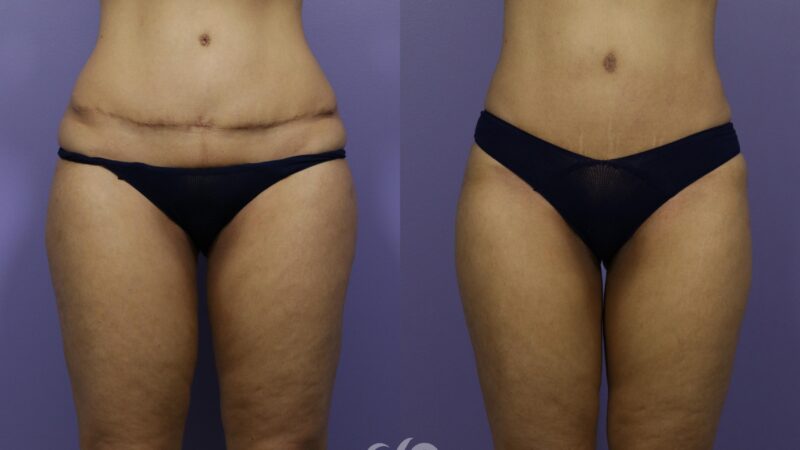 How Long Does It Take to See Tummy Tuck Before and After Results?