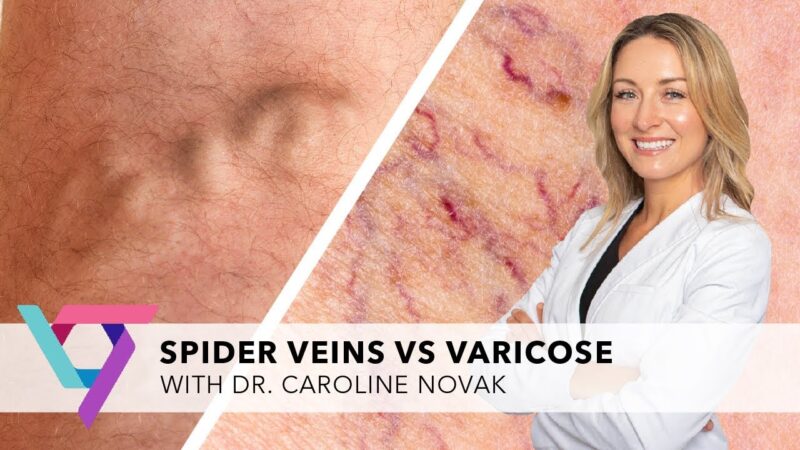 Should You Visit a Vein Specialist or a Cardiologist for Varicose Veins?