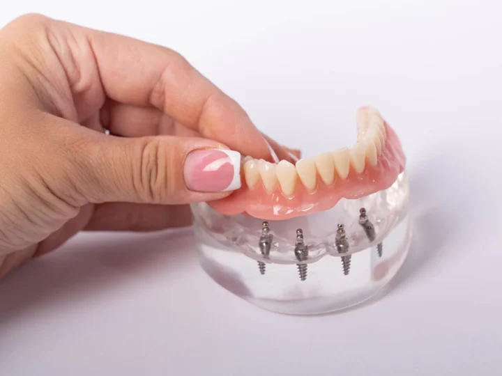 Are Discount Dentures a Good Alternative to Traditional Dentures?