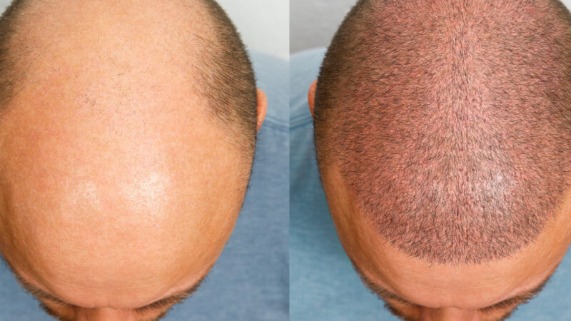 Best Age for Hair Transplant Surgery