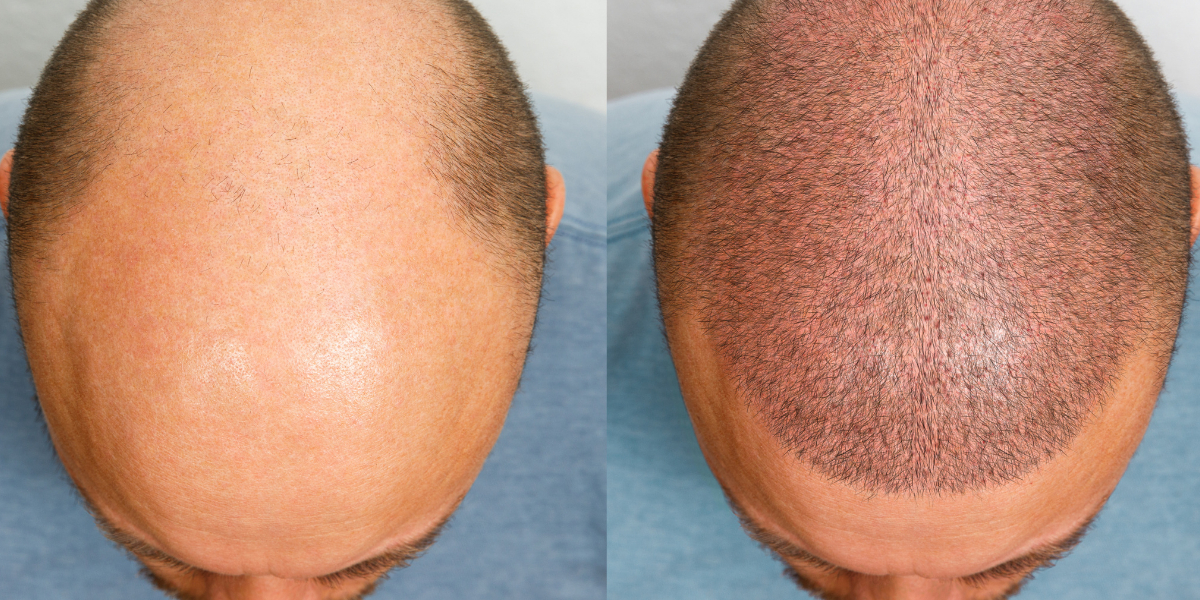 Best Age for Hair Transplant Surgery