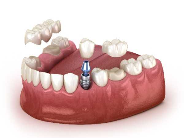 dental implant