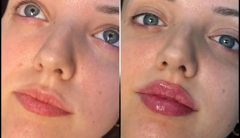 How Much Do Fillers in Dubai Cost in 2025?
