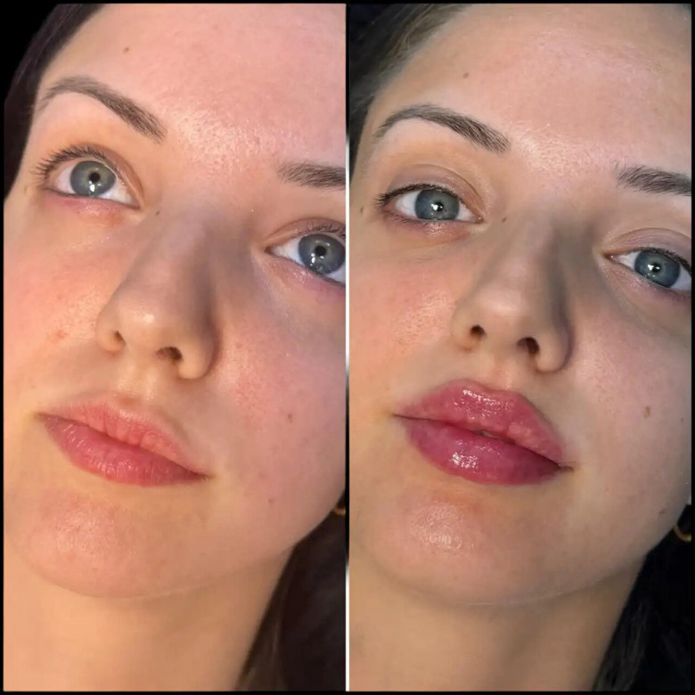 How Much Do Fillers in Dubai Cost in 2025?