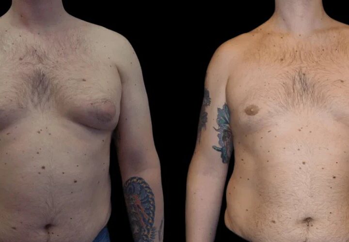 Best Doctors for Budget-Friendly Gynecomastia Surgery in dubai