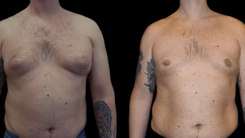 Best Doctors for Budget-Friendly Gynecomastia Surgery in dubai