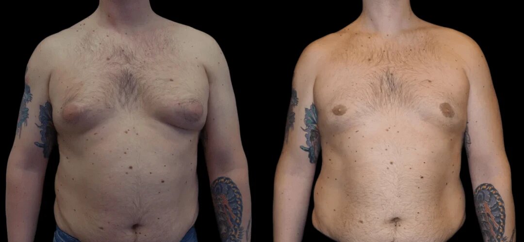Best Doctors for Budget-Friendly Gynecomastia Surgery in dubai 1 Best Doctors for Budget-Friendly Gynecomastia Surgery in dubai