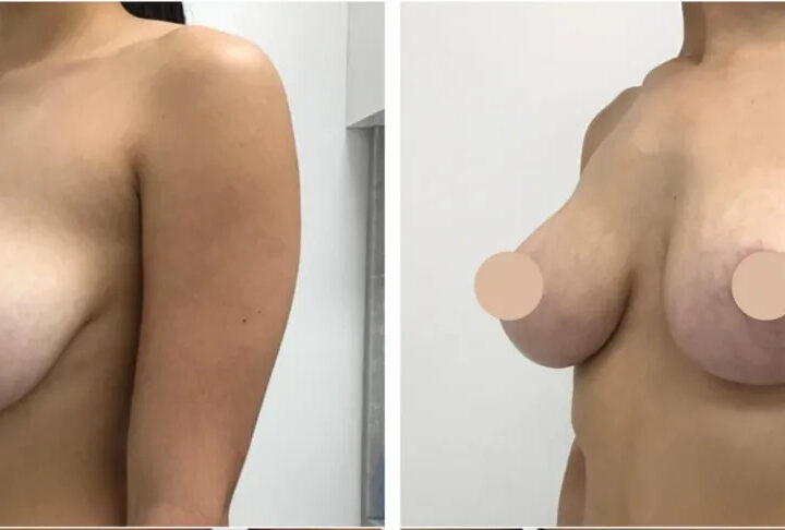 Which Breast Reduction Surgery Procedure Is Right for You in Dubai?