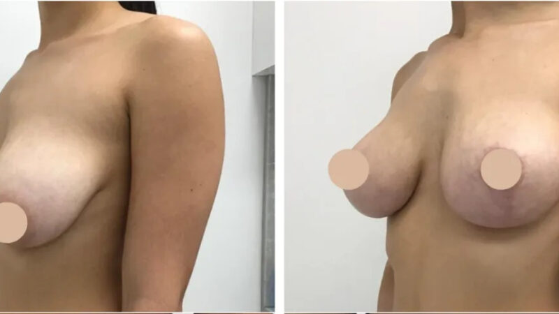 Which Breast Reduction Surgery Procedure Is Right for You in Dubai?