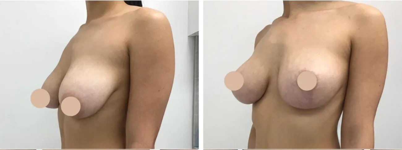 Which Breast Reduction Procedure Is Right for You in Dubai? 1 Which Breast Reduction Procedure Is Right for You in Dubai?