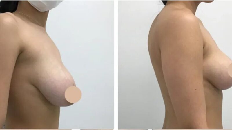 Breast Lift Surgery in dubai: Leading Techniques for Natural Results