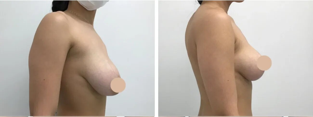 Breast Lift Surgery in dubai: Leading Techniques for Natural Results 1 Breast Lift Surgery in dubai: Leading Techniques for Natural Results