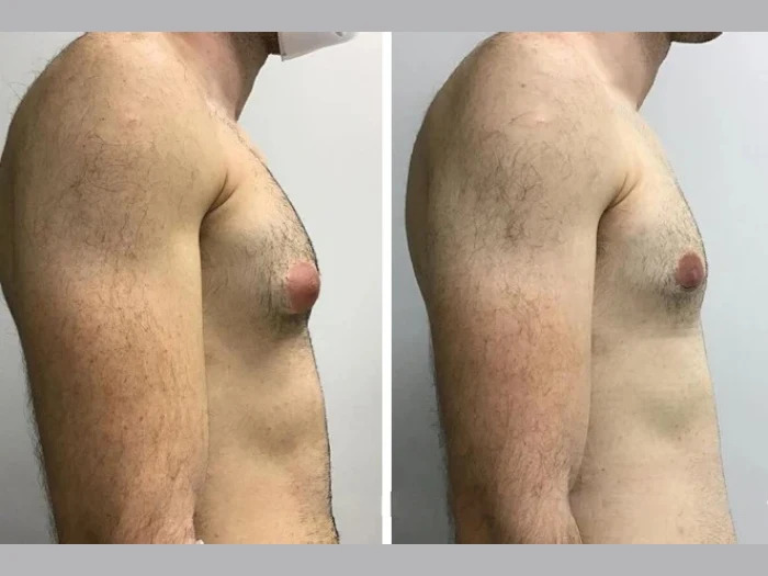 Best Doctors in Dubai for Reliable Gynecomastia Cost in Dubai 1 Best Doctors in Dubai for Reliable Gynecomastia Cost in Dubai