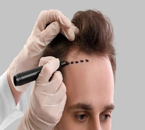 مراكز زراعة الشعر في شرق الرياض: خيارات متعددة
