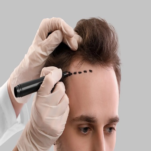 مراكز زراعة الشعر في شرق الرياض: خيارات متعددة 1 مراكز زراعة الشعر في شرق الرياض: خيارات متعددة