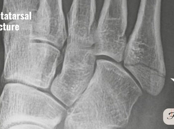 Top 5 Causes of Hairline Fracture Foot—and How to Prevent Them