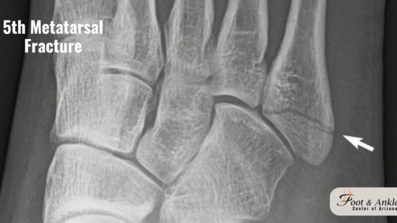 Top 5 Causes of Hairline Fracture Foot—and How to Prevent Them