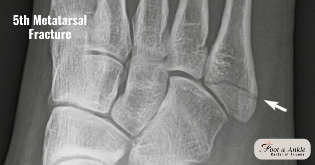 Top 5 Causes of Hairline Fracture Foot—and How to Prevent Them 1 Top 5 Causes of Hairline Fracture Foot—and How to Prevent Them