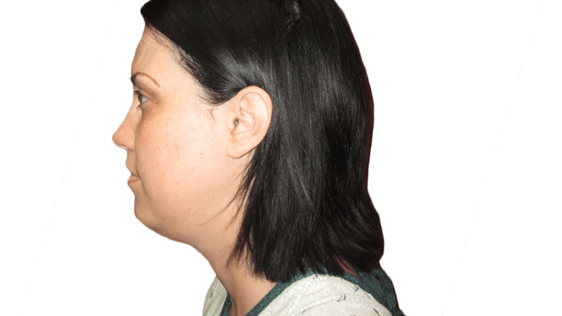 What Is Neck Liposuction and How Does It Work?