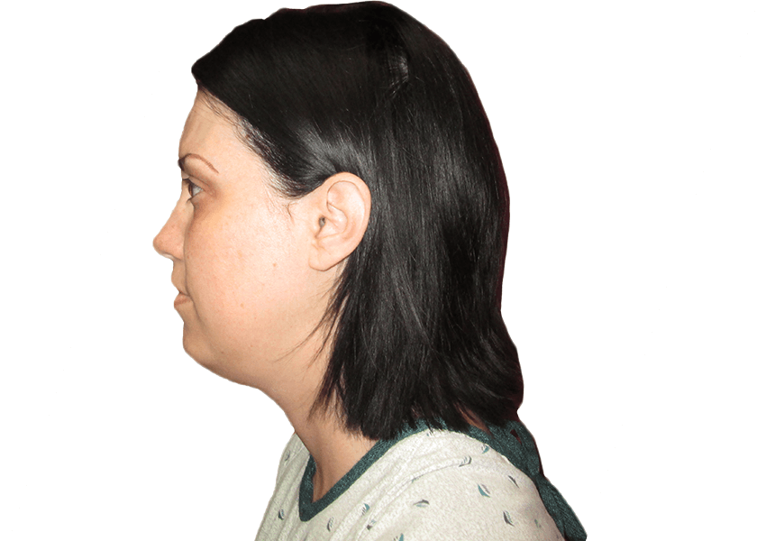 What Is Neck Liposuction and How Does It Work?