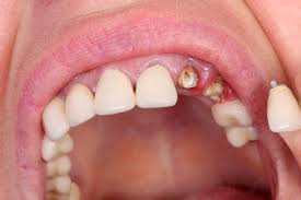 Why Choosing the Right Prosthodontist Near Me Can Transform Your Oral Health