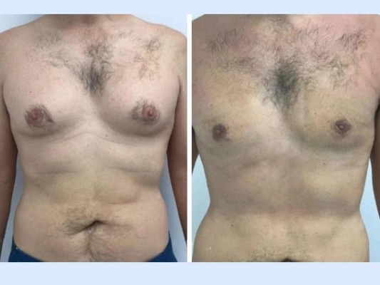 Best Gynecomastia Surgeons in Dubai for Health and Aesthetic Goals