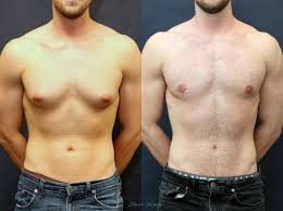 How to Prepare for Gynecomastia Surgery Near Me