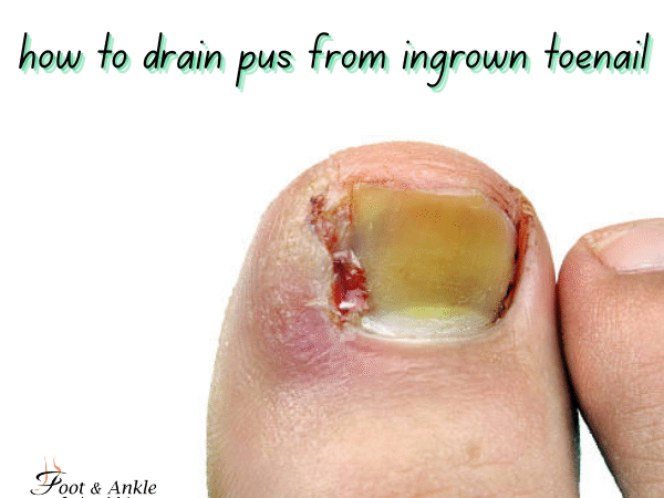 How to Drain Pus from an Ingrown Toenail Safely at Home (Step-by-Step Guide)
