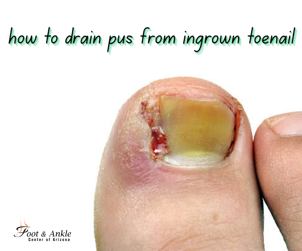 How to Drain Pus from an Ingrown Toenail Safely at Home (Step-by-Step Guide)