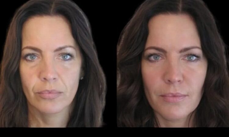 Cost of Jawline Fillers with the Best Plastic Surgeons in Dubai – What to Expect